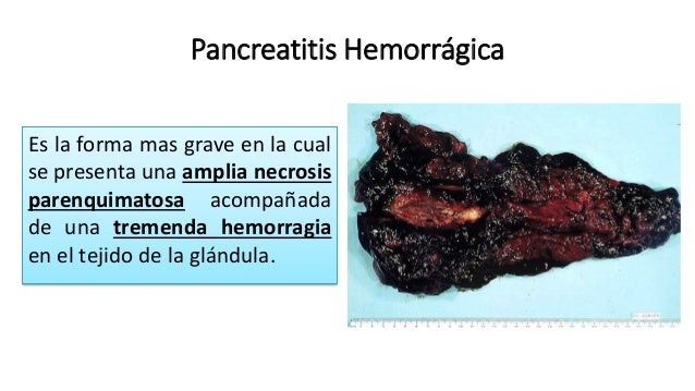 pancreatitis hemorragica